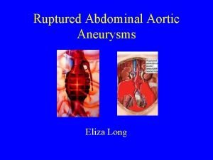 Ruptured Abdominal Aortic Aneurysms Eliza Long Treatment of