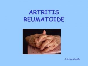 ARTRITIS REUMATOIDE Cristina Capilla Definicin La Artritis Reumatoide