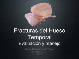 Fracturas del Hueso Temporal Evaluacin y manejo Carlos