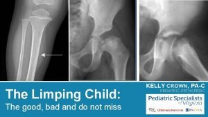 Legg calve perthes disease vs scfe