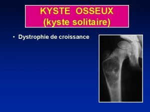 KYSTE OSSEUX kyste solitaire Dystrophie de croissance KYSTE