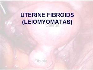 UTERINE FIBROIDS LEIOMYOMATAS What are they Smooth Muscle