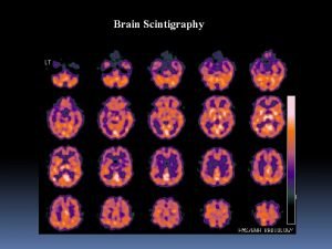 Brain Scintigraphy Brain Scintigraphy Brain Scintigraphy Brain Scintigraphy