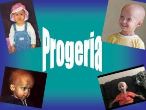 Alternative Names HutchinsonGilford Syndrome HutchinsonGilford Progeria HutchinsonGilford Disease