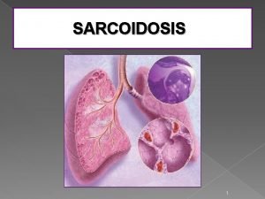 SARCOIDOSIS 1 SARCOIDOSIS Epidemiology etiology pathophysiology Dr ADITI