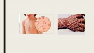 Pleomorphism in chicken pox