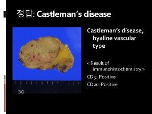 Castlemans disease hyaline vascular type Result of immunohistochemistry