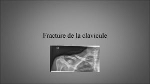 Rx clavicule