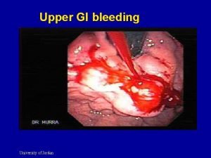 Signs of upper gi bleed