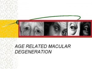 AGE RELATED MACULAR DEGENERATION An epidemic of ageing
