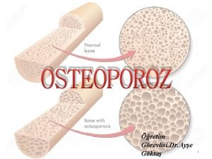 OSTEOPOROZ retim Grevlisi Dr Aye Gkta 1 Osteoporoz