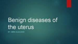 Benign tumors in the uterus