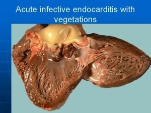 Acute infective endocarditis with vegetations Ventricular Aneurysm complicating