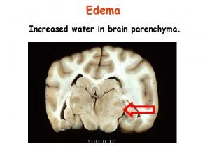 Brain parenchyma