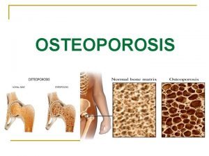 OSTEOPOROSIS Definition n Osteoporosis is defined as a