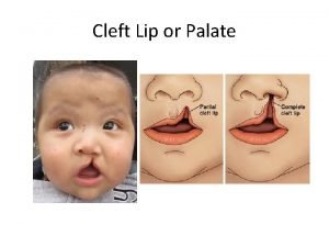 Cleft Lip or Palate Cleft Lip A facial