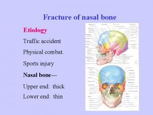 Fracture of nasal bone Etiology Traffic accident Physical