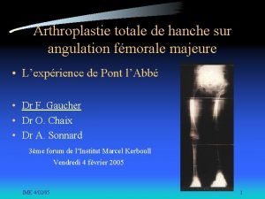 Arthroplastie totale de hanche sur angulation fmorale majeure