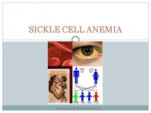 SICKLE CELL ANEMIA ADELINE OLANIRAN What is Sickle