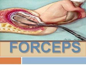 FORCEPS DEFINITION Obstetrics forceps is a pair of