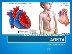 Tratamiento coartacion aortica