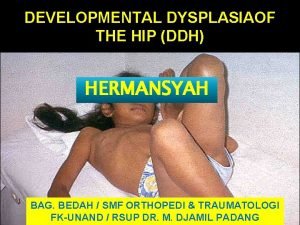 DEVELOPMENTAL DYSPLASIAOF THE HIP DDH HERMANSYAH BAG BEDAH