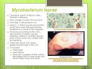 Mycobacterium leprae Causative agent of leprosy aka Hansens