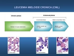 LEUCEMIA MIELOIDE CRONICA CML Chronic phase Advanced phase