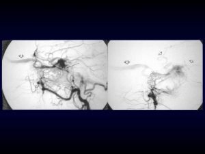 Dural Arteriovenous Fistulae Static or Dynamic Cognard et