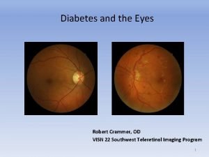 Diabetes and the Eyes Robert Crammer OD VISN