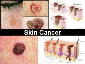 Skin Cancer Introduction All life on Earth depends