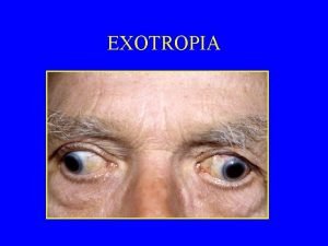 EXOTROPIA EXOTROPIA DR LIONEL KOWAL FRANZCO FRACS MELBOURNE