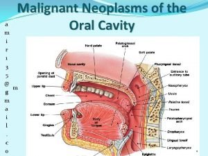 Floor of mouth cancer