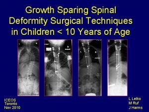 Growth Sparing Spinal Deformity Surgical Techniques in Children