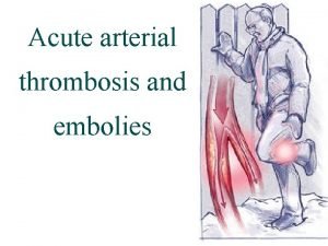 Acute arterial thrombosis and embolies Prevalence Acute arterial