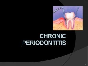 CHRONIC PERIODONTITIS 1 Definition Chronic Periodontitis can be