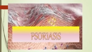 Overview Psoriasis is a skin disease that causes
