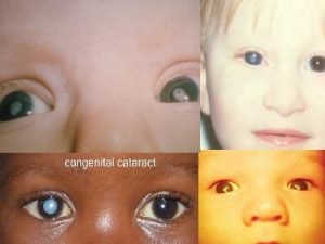 Cerulean cataract