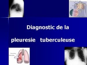 Diagnostic de la pleuresie tuberculeuse Diagnostic clinique v