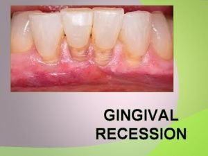 Definition of gingival recession