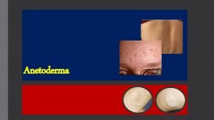 Anetoderma Definition The term anetoderma refers to a