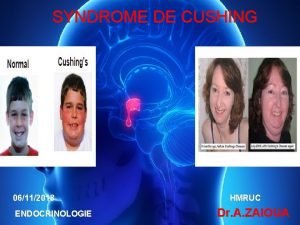 SYNDROME DE CUSHING 06112018 HMRUC ENDOCRINOLOGIE Dr A