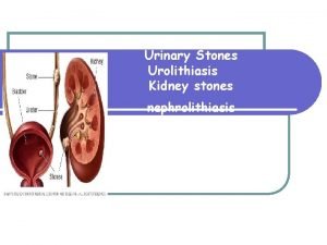 Urinary Stones Urolithiasis Kidney stones nephrolithiasis Kidney stones