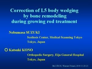Correction of L 5 body wedging by bone