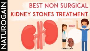 Treatment for Kidney Stones The stones in the