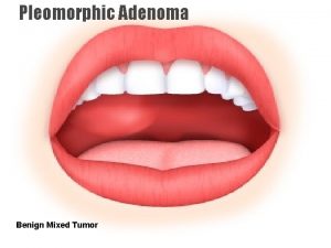 Pleomorphic Adenoma Benign Mixed Tumor the most common