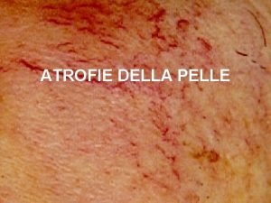 ATROFIE DELLA PELLE Atrofie della pelle In diverse