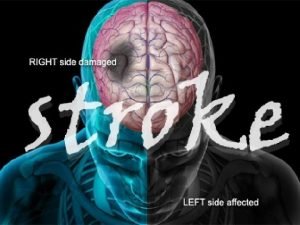 Stroke adalah gangguan fungsional otak fokal maupun global
