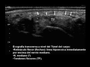 TF Ecografa transversa a nivel del Tnel del