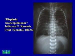 Displasia broncopulmonar Jefferson G Resende Unid Neonatol HRASSESDF